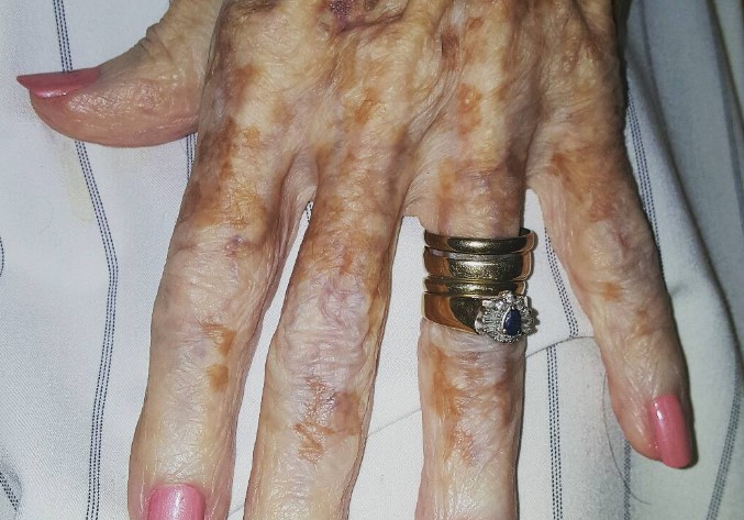 Nurse takes photo of old lady’s hand – then sees detail in the picture that has the internet exploding