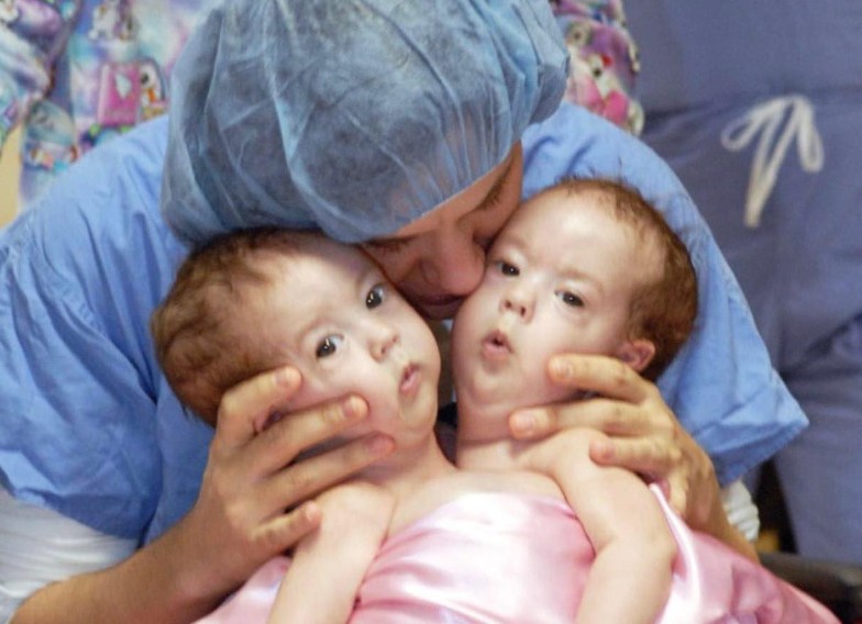 Conjoined Twins Bella And Abby Were Genuinely Associated From Birth, Yet Medical Procedure Changed Everything