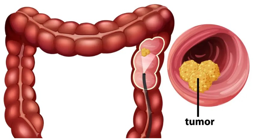 How Your Bowel Movements Reveal Clues About Colon Cancer